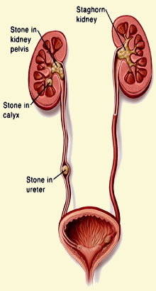 kidney stones